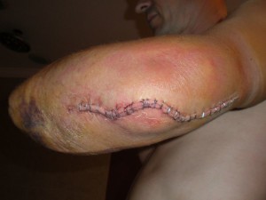 Elbow After Surgery