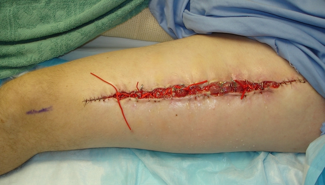 Left Leg Post Surgery